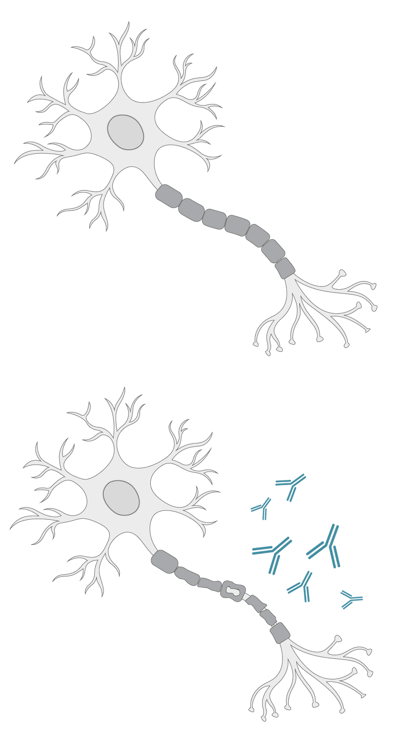 Multiple sclerosis